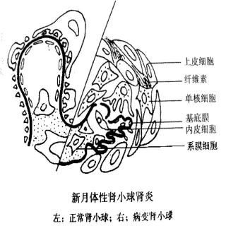 新月体性肾炎(一)