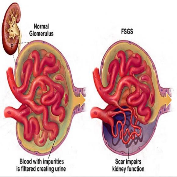 局灶节段性肾小球硬化一fsgs