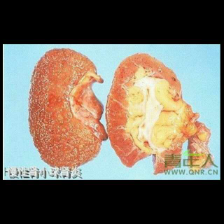 【常见的肾小球肾炎的诊断标准】在线收听_1211@华_荔枝