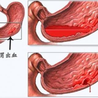 上消化道出血的知识点