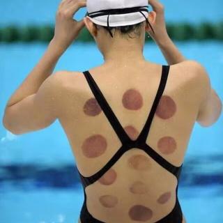 【拔罐治疗法】里约奥运会运动员身上的圆紫痕印记：拔罐解除疼痛
