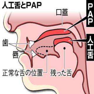 天下新知：日本研发人工舌头能帮助受损者清晰发声