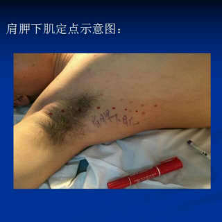 淄博高雨医师分享：肩胛下肌损伤的诊断与治疗