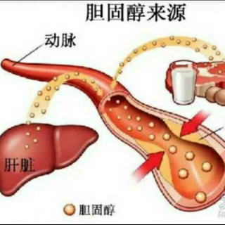 高胆固醇与胆道系统疾病