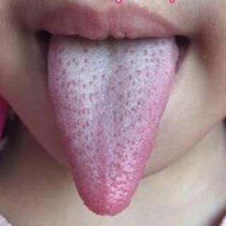 【舌象167】舌象分析：瘦小草莓舌、白腻苔