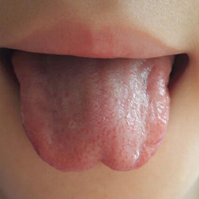 【第1011期】心脾两虚型多动症的舌象