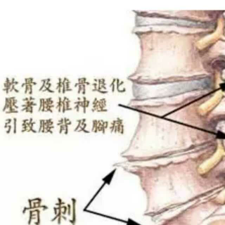 骨质增生，椎管狭窄，O型腿怎么治疗？可以通过运动痊愈吗？