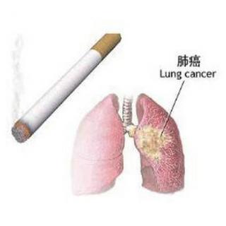 全球第一癌症杀手——肺癌，该如何早查？