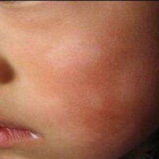 第五十六期：宝宝脸上的白斑是怎么了？