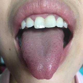 舌象116蒸笼头的舌象解析