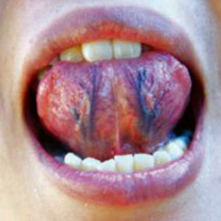 舌下络脉诊法