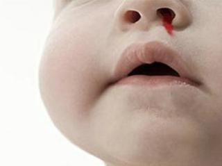 第4期 小儿流鼻血分型辩证以及家庭处理