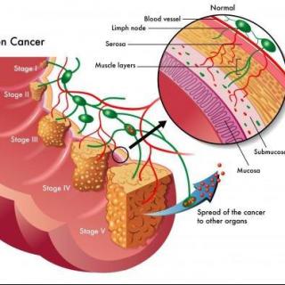 如何阻断息肉变成肠癌之路 