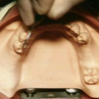 牙体缺损的修复（嵌体与部分冠）