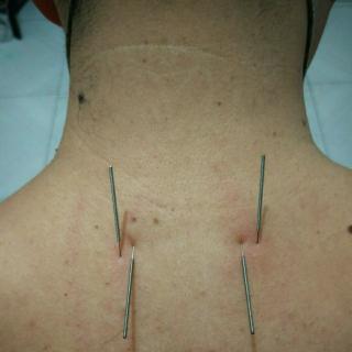 王宾三五针灸—颈胸两针及相关病例讲解