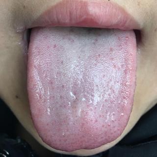 气虚血虚的舌苔图片图片