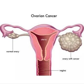关注女性健康，卵巢癌,了解一下？