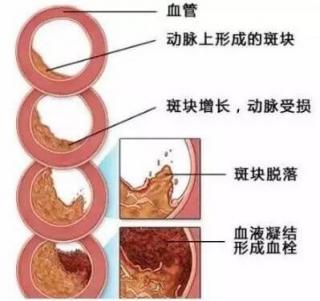 高血压的形成