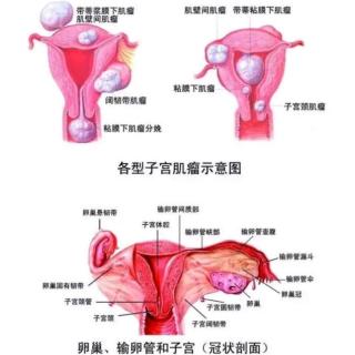第71期--子宫肌瘤是怎么形成的？