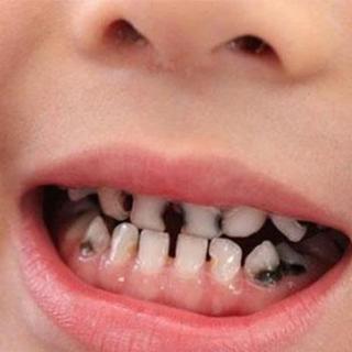 47~牙齿变黑的原因及预防