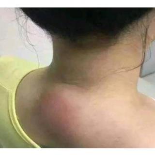 小心富贵包要了你的命