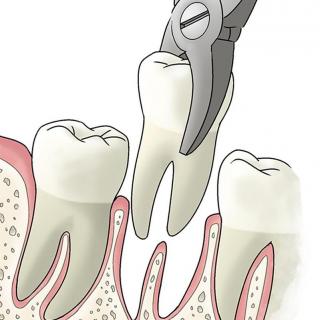 加拿大牙齿矫正之拔牙