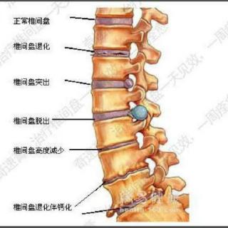 腰椎间盘突出坐骨神经痛产生原因及解决方案