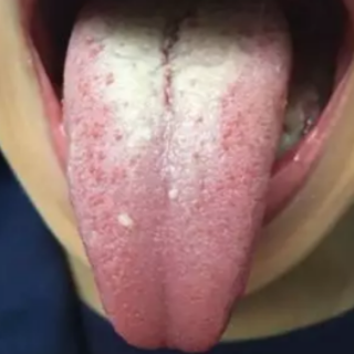 孩子舌后区有裂痕怎么回事？