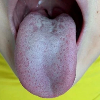 脊柱与舌中线的关系