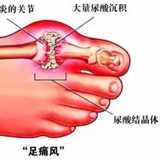 营养健康知识分享《高尿酸血症与痛风这对：“亲兄弟”》