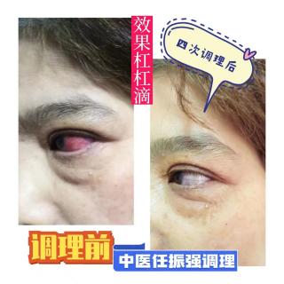 中医任振强老师分享――眼疾辩证及的治疗