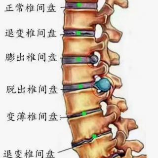 腰椎间盘突出、坐骨神经痛、颈椎的前世今生1